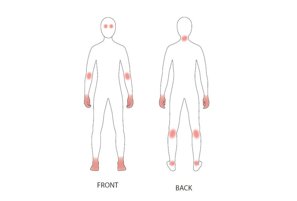 adolescent-dermatitis.png