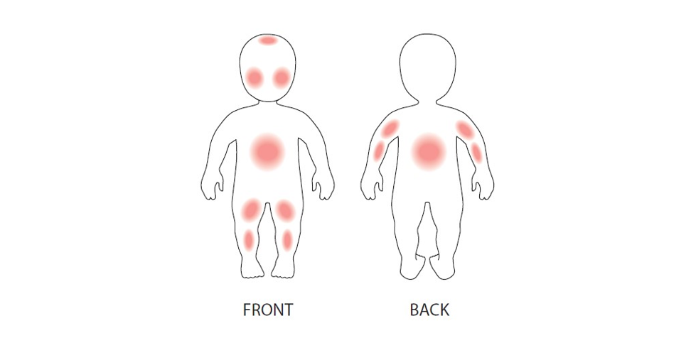 infant-dermatitis.png