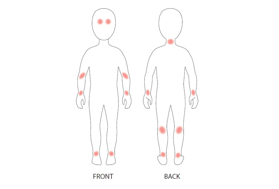 young-children-dermatitis.png